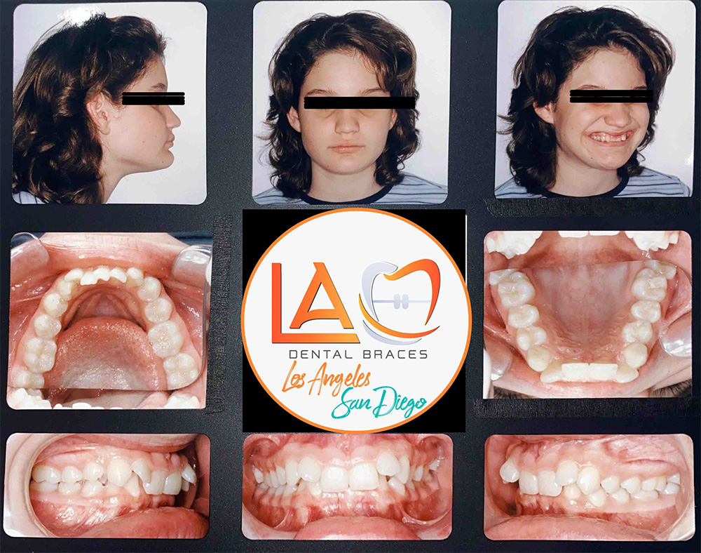 Before and After Photos LA Dental Braces